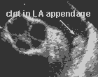 Picture of Thrombus In LAA